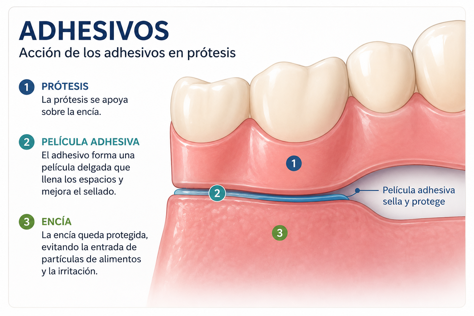 Diagrama: acción de los adhesivos en prótesis